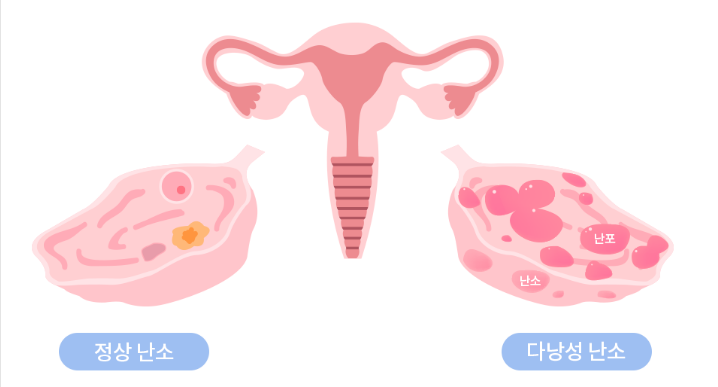 다낭성 난소 증후군 원인 증상 비만 관련성 치료법